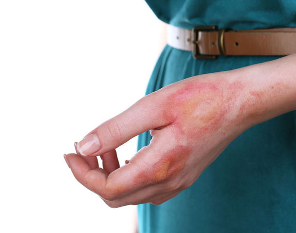 Oparzenia. Jakie opatrunki wybrać? Jak złagodzić ból? Odpowiadamy