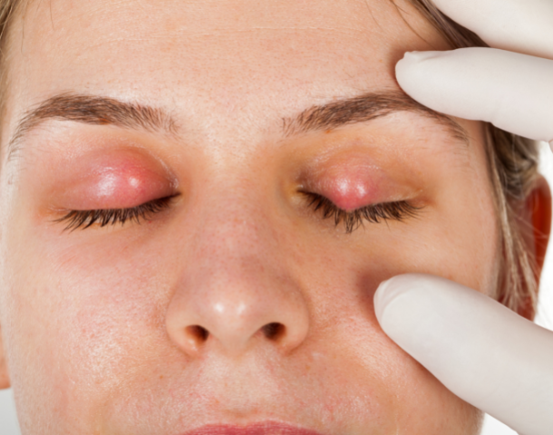 Skutki braku dezynfekcji w gabinetach fryzjerskich i kosmetycznych